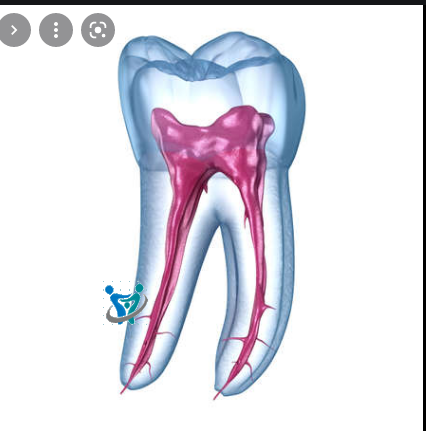 علاج الضرس المحفور